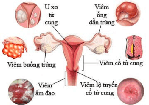 Bệnh phụ khoa nữ thường gặp 